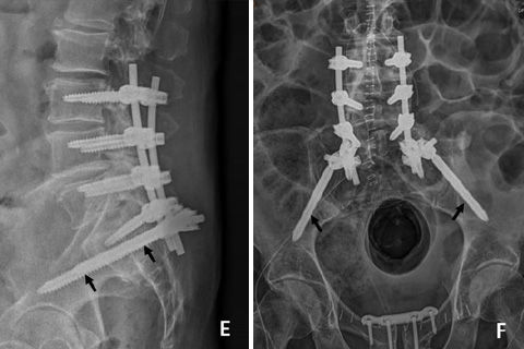 X-Rays of the spine with implants
