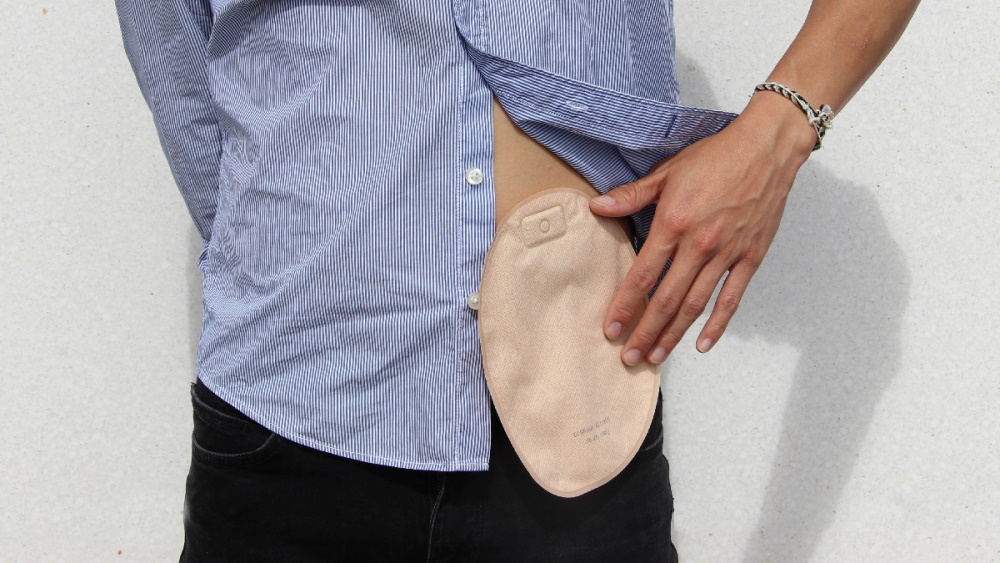What is a Stoma? Stoma Function and Types Explained - B. Braun