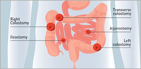 Types Of Ostomy: Colostomy, Ileostomy, And Urostomy – DZED