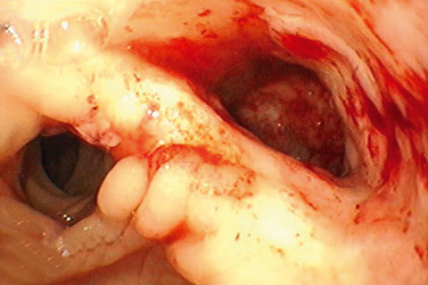 sponge endo cavity possible bbraun