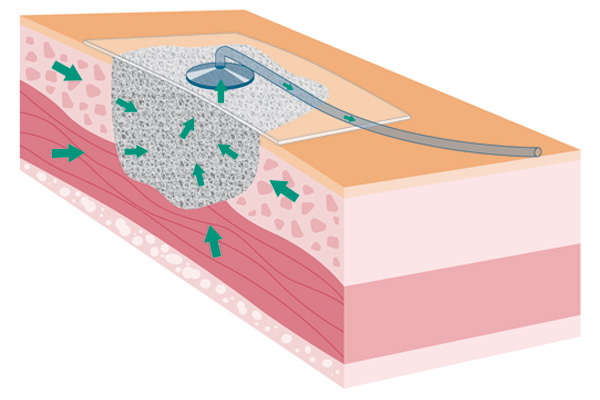 Vacuum therapy 1